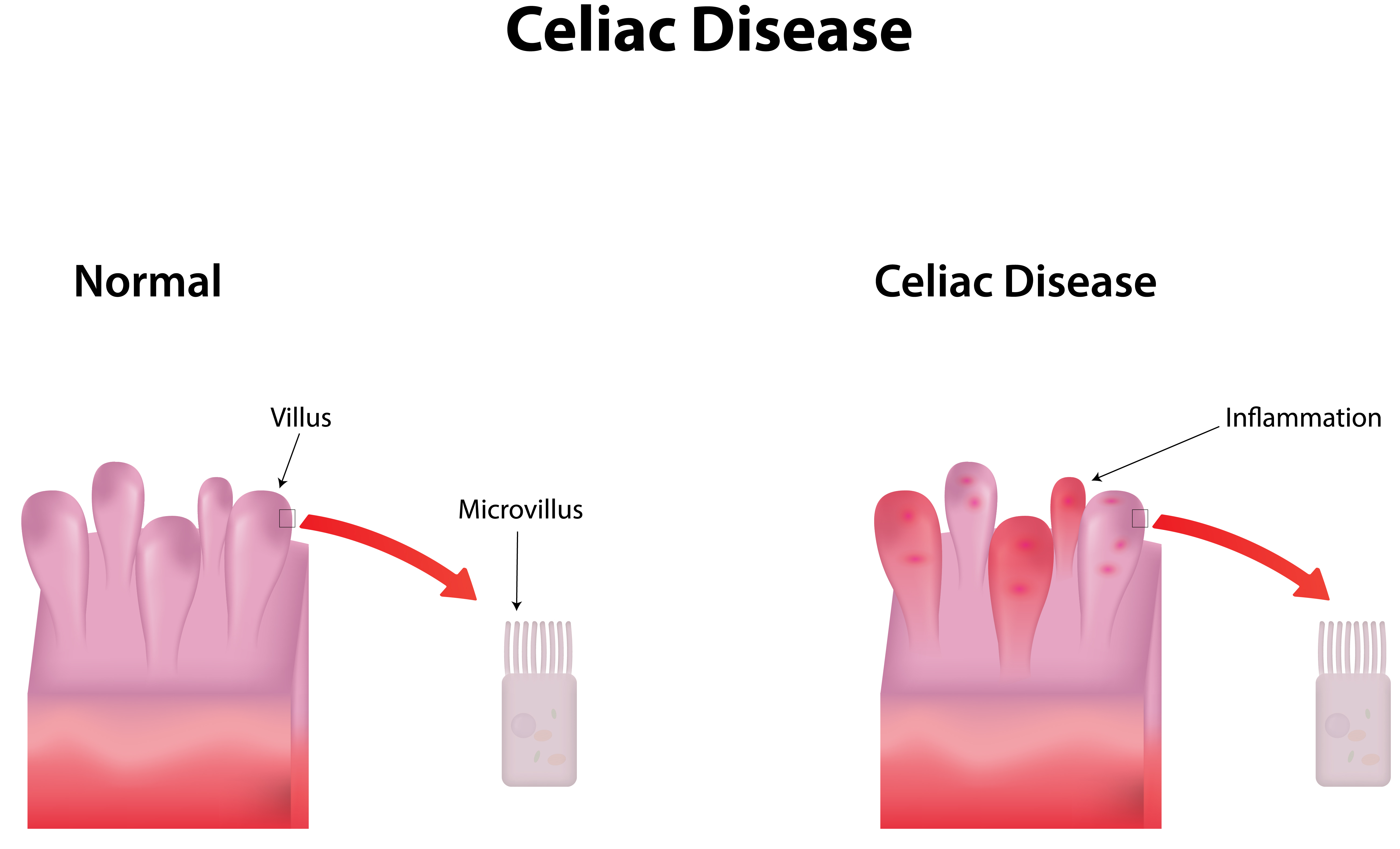 Celiac Disease System Disorder Template