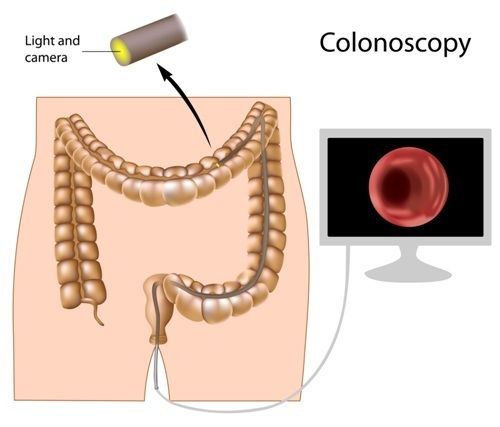 Colonoscopy of ulcerative colitis and bowel inflammation