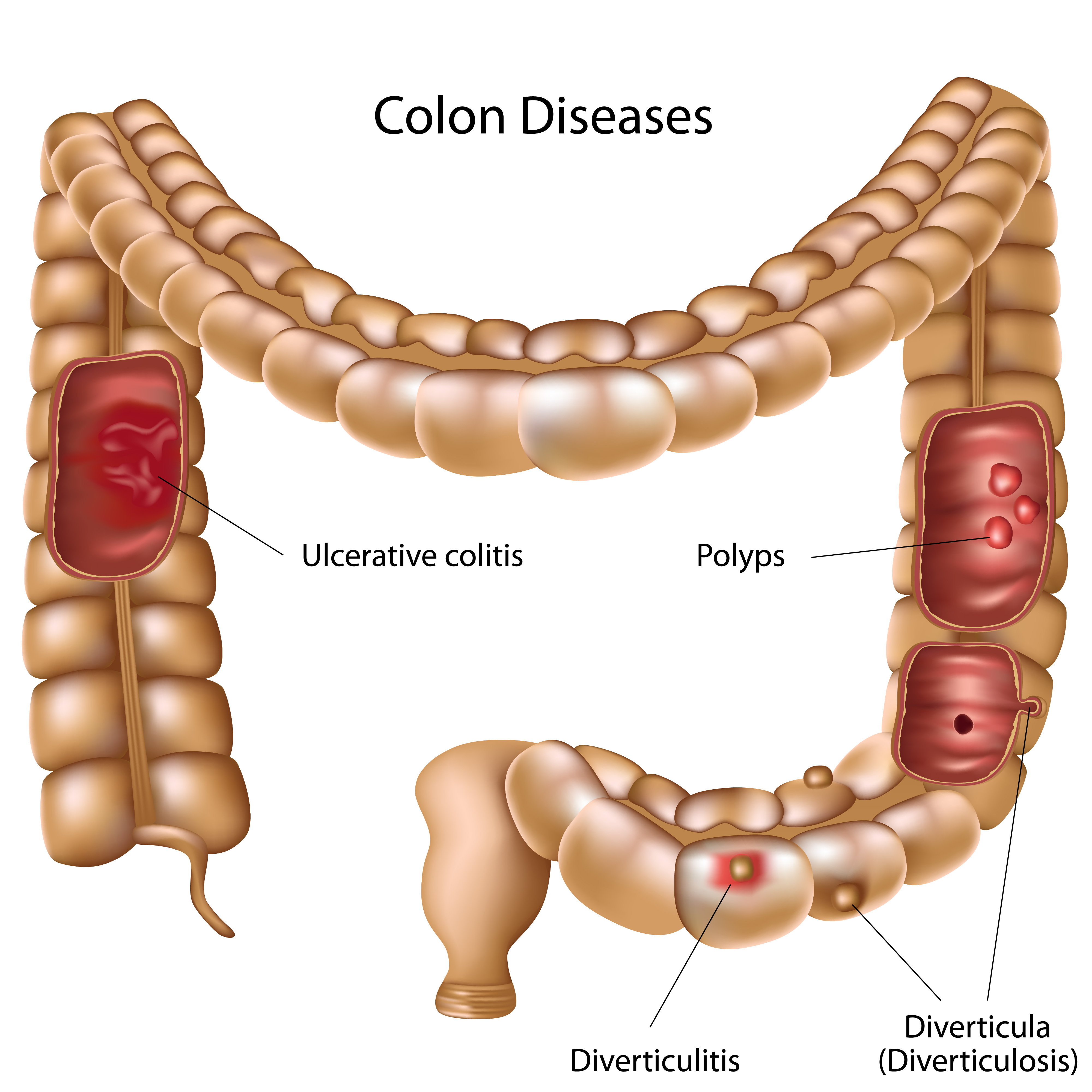 Ulcerative Colitis - Jackson Siegelbaum Gastroenterology