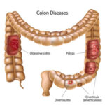 Diverticulosis & Diverticulitis - Jackson Siegelbaum Gastroenterology