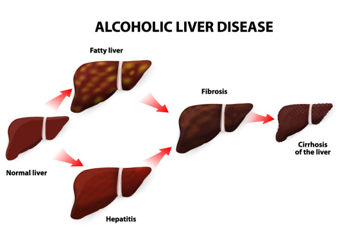 Fatty Liver : GiCare.com