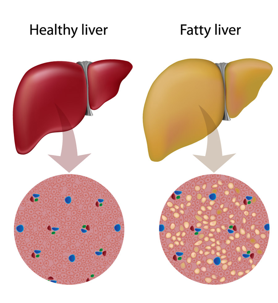 Fatty Liver GiCare