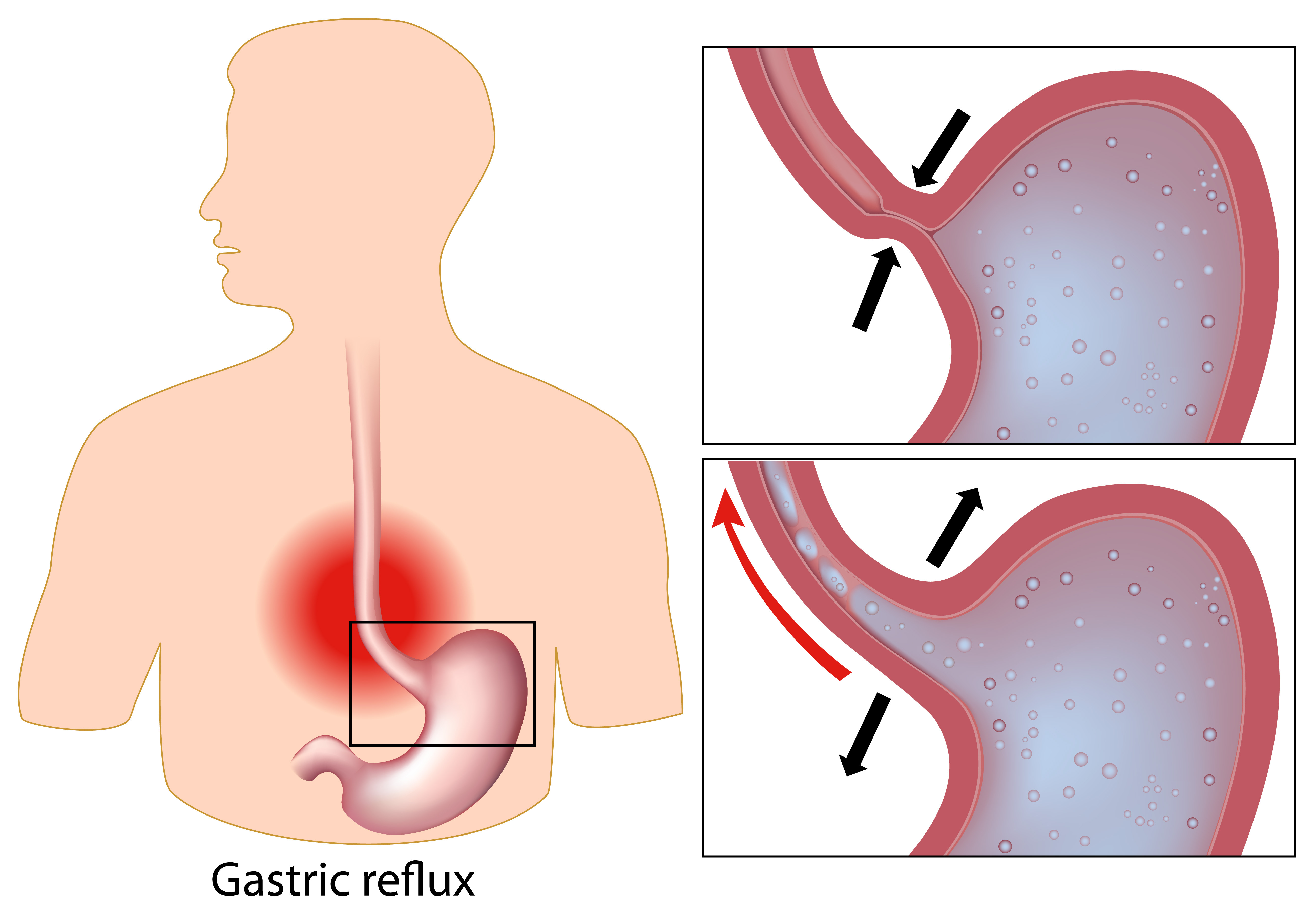 Unveiling The Connection Between Stress and Acid Reflux