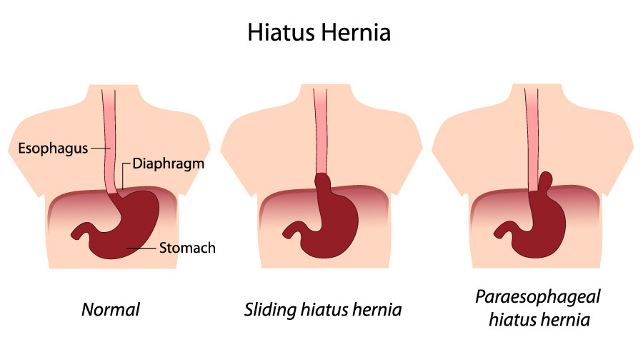 Hiatus Hernia