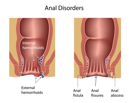 Hemorrhoids